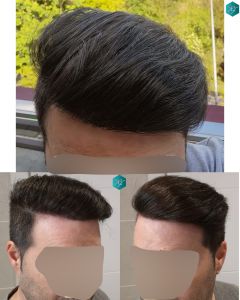 Injerto Capilar Técnica FUE 6557 Grafts (14215 Pelos) 97 124 COMPARATIVA