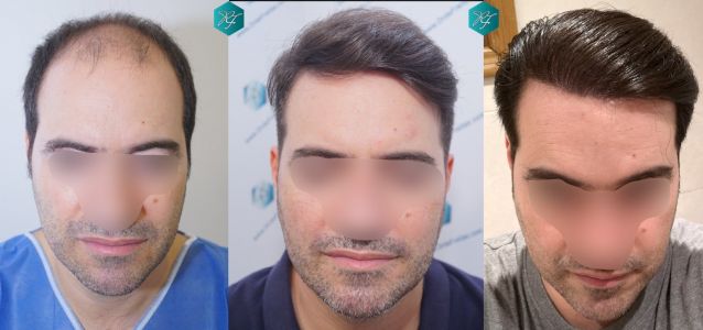 Injerto Capilar Técnica FUE 6557 Grafts (14215 Pelos) 98 resultados trasplante capilar