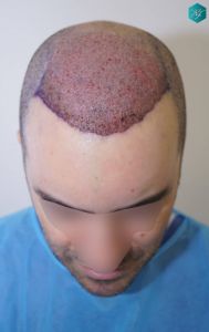 Injerto Capilar Técnica FUE 6557 Grafts (14215 Pelos) 10 13 TRASPLANTE