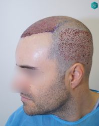 Injerto Capilar Técnica FUE 6557 Grafts (14215 Pelos) 11 14 TRASPLANTE 1