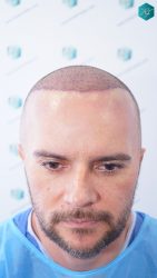 TRASPLANTE CAPILAR INJERTO CAPILAR