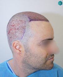 Injerto Capilar Técnica FUE 6557 Grafts (14215 Pelos) 12 15 TRASPLANTE 1