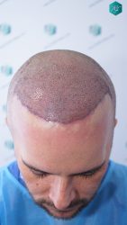 Injerto Capilar Técnica FUE Grafts 3223 (9295 Pelos) 13 INJERTO CAPILAR