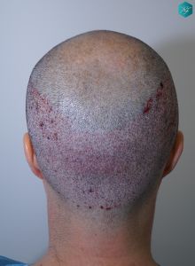 Injerto Capilar Técnica FUE 6557 Grafts (14215 Pelos) 13 16 TRASPLANTE 1