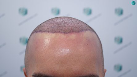 Injerto Capilar Técnica FUE Grafts 3223 (9295 Pelos) 14 16 TRASPLANTE