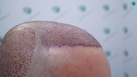 Injerto Capilar Técnica FUE Grafts 3223 (9295 Pelos) 15 INJERTO CAPILAR