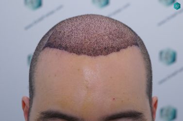 Injerto Capilar Técnica FUE 6557 Grafts (14215 Pelos) 14 18 A LOS 3 DIAS