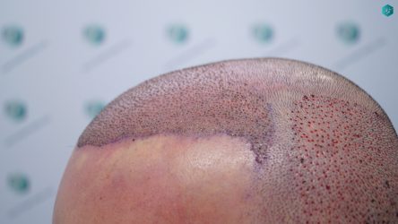 Injerto Capilar Técnica FUE Grafts 3223 (9295 Pelos) 16 INJERTO CAPILAR