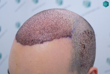Injerto Capilar Técnica FUE 6557 Grafts (14215 Pelos) 15 19 A LOS 3 DIAS