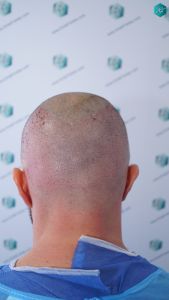 Injerto Capilar Técnica FUE Grafts 3223 (9295 Pelos) 17 INJERTO CAPILAR