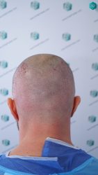 Injerto Capilar Técnica FUE Grafts 3223 (9295 Pelos) 17 INJERTO CAPILAR