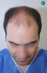Injerto Capilar Técnica FUE 6557 Grafts (14215 Pelos) 1 2 ANTES 1