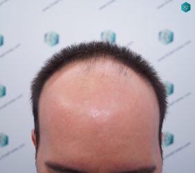 Injerto Capilar Técnica FUE Grafts 3223 (9295 Pelos) 2 ANTES DEL TRASPLANTE CAPILAR