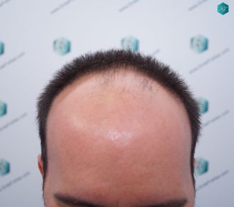 Injerto Capilar Técnica FUE Grafts 3223 (9295 Pelos) 2 ANTES DEL TRASPLANTE CAPILAR
