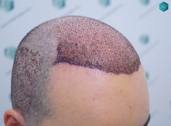Injerto Capilar Técnica FUE 6557 Grafts (14215 Pelos) 16 20 A LOS 3 DIAS