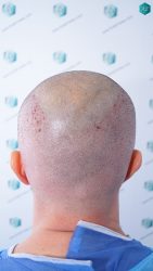 Injerto Capilar Técnica FUE Grafts 3223 (9295 Pelos) 18 INJERTO CAPILAR