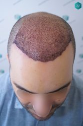 Injerto Capilar Técnica FUE 6557 Grafts (14215 Pelos) 17 21 A LOS 3 DIAS