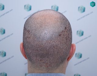 Injerto Capilar Técnica FUE 6557 Grafts (14215 Pelos) 18 22 A LOS 3 DIAS