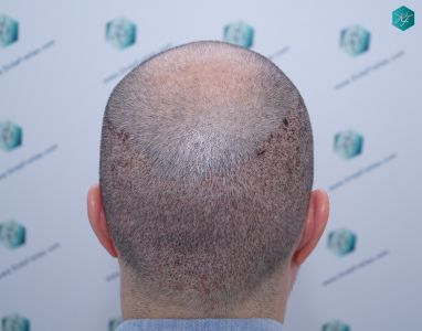 Injerto Capilar Técnica FUE 6557 Grafts (14215 Pelos) 18 22 A LOS 3 DIAS