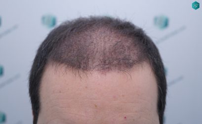 Injerto Capilar Técnica FUE 6557 Grafts (14215 Pelos) 19 24 EN 3 MESES