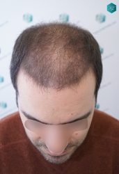 Injerto Capilar Técnica FUE 6557 Grafts (14215 Pelos) 20 25 EN 3 MESES