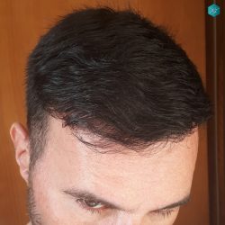 Injerto Capilar Técnica FUE Grafts 3223 (9295 Pelos) 19 RESULTADOS AL 7º MES