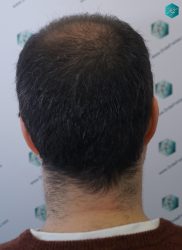Injerto Capilar Técnica FUE 6557 Grafts (14215 Pelos) 21 26 EN 3 MESES