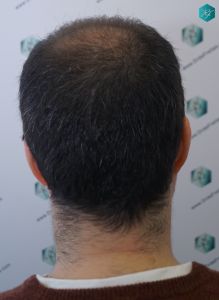 Injerto Capilar Técnica FUE 6557 Grafts (14215 Pelos) 21 26 EN 3 MESES