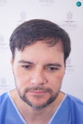 RETOQUE INJERTO CAPILAR RETOQUE INJERTO CAPILAR