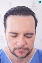 Injerto Capilar Técnica FUE Grafts 3223 (9295 Pelos) 20 RETOQUE INJERTO CAPILAR