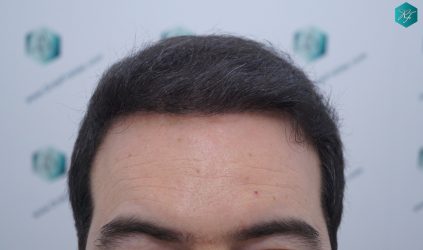 Injerto Capilar Técnica FUE 6557 Grafts (14215 Pelos) 22 28 EN 6 MESES