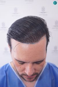 Injerto Capilar Técnica FUE Grafts 3223 (9295 Pelos) 21 RETOQUE INJERTO CAPILAR