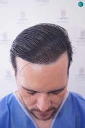 Injerto Capilar Técnica FUE Grafts 3223 (9295 Pelos) 21 RETOQUE INJERTO CAPILAR