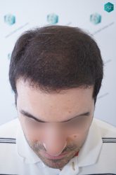 Injerto Capilar Técnica FUE 6557 Grafts (14215 Pelos) 23 29 EN 6 MESES
