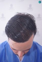 Injerto Capilar Técnica FUE Grafts 3223 (9295 Pelos) 22 RETOQUE INJERTO CAPILAR