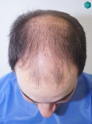 Injerto Capilar Técnica FUE 6557 Grafts (14215 Pelos) 2 3 ANTES 1