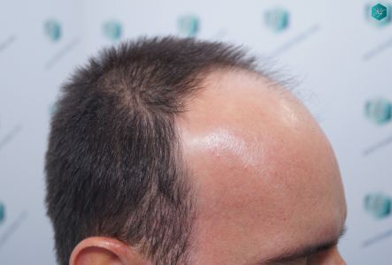 Injerto Capilar Técnica FUE Grafts 3223 (9295 Pelos) 3 ANTES DEL TRASPLANTE CAPILAR