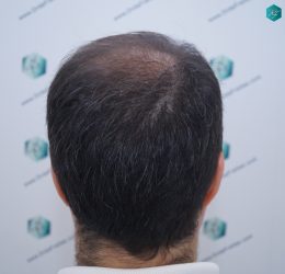 Injerto Capilar Técnica FUE 6557 Grafts (14215 Pelos) 24 30 EN 6 MESES