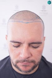 Injerto Capilar Técnica FUE Grafts 3223 (9295 Pelos) 23 RETOQUE INJERTO CAPILAR