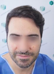 Injerto Capilar Técnica FUE 6557 Grafts (14215 Pelos) 25 RESULTADOS EN 12 MESES
