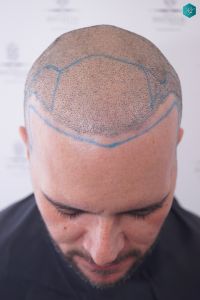 Injerto Capilar Técnica FUE Grafts 3223 (9295 Pelos) 24 RETOQUE INJERTO CAPILAR