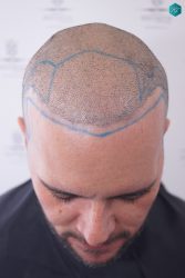 Injerto Capilar Técnica FUE Grafts 3223 (9295 Pelos) 24 RETOQUE INJERTO CAPILAR