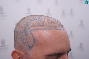 Injerto Capilar Técnica FUE Grafts 3223 (9295 Pelos) 25 RETOQUE INJERTO CAPILAR