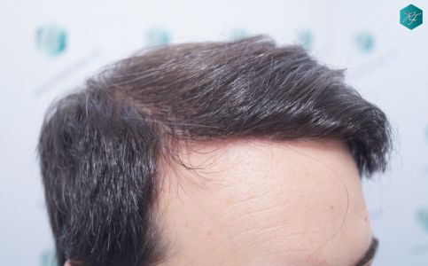 Injerto Capilar Técnica FUE 6557 Grafts (14215 Pelos) 27 33 EN 12 MESES