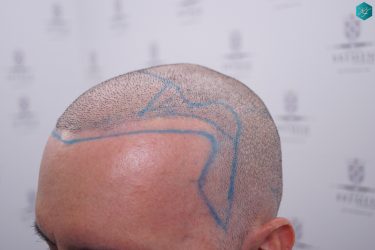Injerto Capilar Técnica FUE Grafts 3223 (9295 Pelos) 26 RETOQUE INJERTO CAPILAR