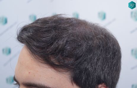 Injerto Capilar Técnica FUE 6557 Grafts (14215 Pelos) 28 34 EN 12 MESES