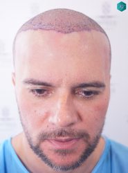Injerto Capilar Técnica FUE Grafts 3223 (9295 Pelos) 27 RETOQUE INJERTO CAPILAR