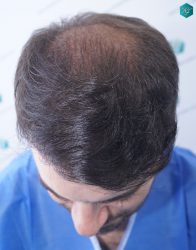 Injerto Capilar Técnica FUE 6557 Grafts (14215 Pelos) 29 35 EN 12 MESES