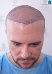 Injerto Capilar Técnica FUE Grafts 3223 (9295 Pelos) 28 RETOQUE INJERTO CAPILAR