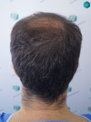 Injerto Capilar Técnica FUE 6557 Grafts (14215 Pelos) 30 36 EN 12 MESES